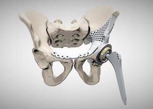 پرینت سه بعدی پروتز لگن